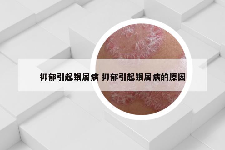 抑郁引起银屑病 抑郁引起银屑病的原因