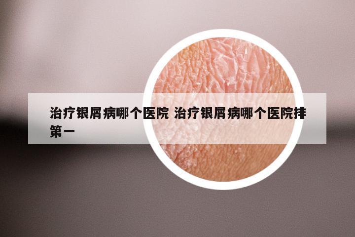 治疗银屑病哪个医院 治疗银屑病哪个医院排第一
