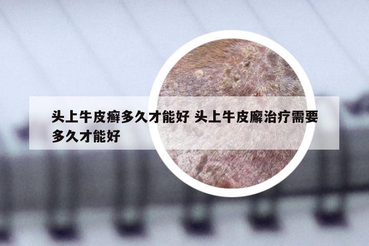 头上牛皮癣多久才能好 头上牛皮廨治疗需要多久才能好