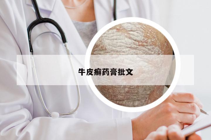 牛皮癣药膏批文