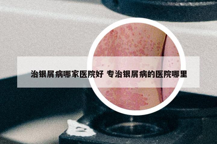 治银屑病哪家医院好 专治银屑病的医院哪里