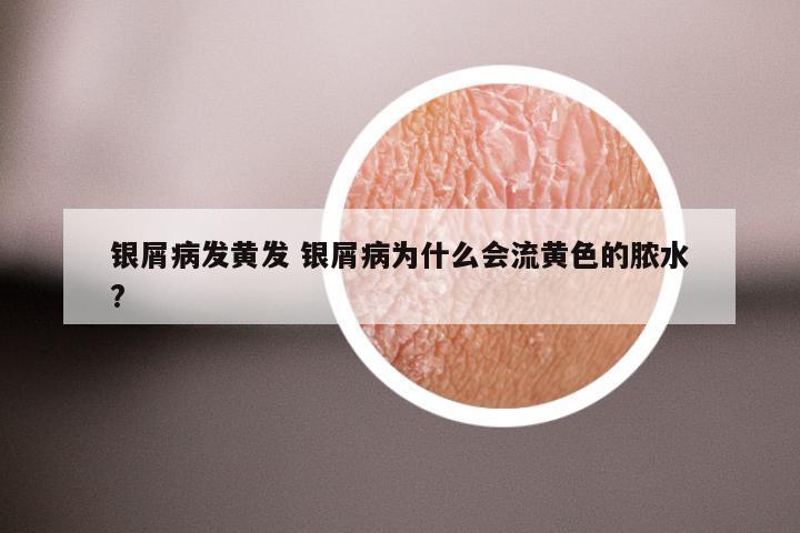 银屑病发黄发 银屑病为什么会流黄色的脓水?