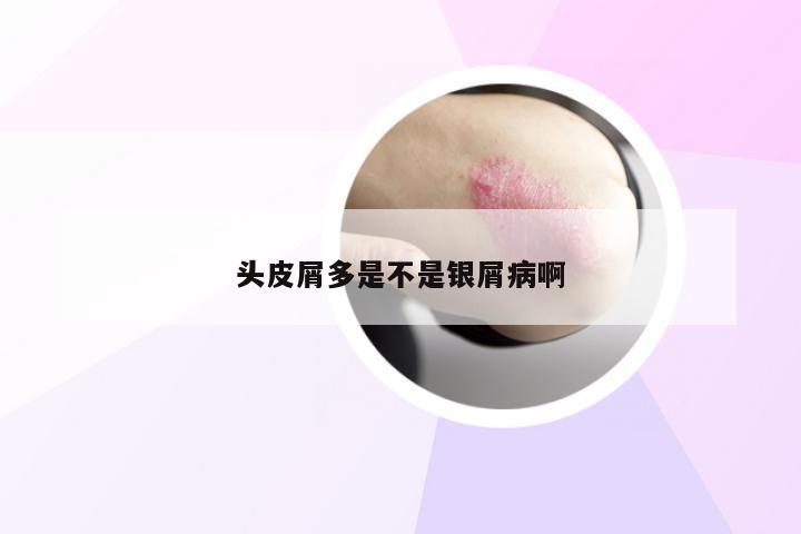 头皮屑多是不是银屑病啊