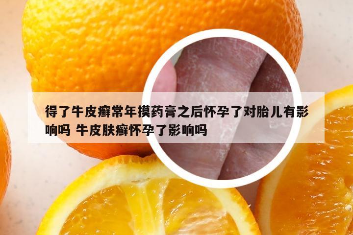 得了牛皮癣常年摸药膏之后怀孕了对胎儿有影响吗 牛皮肤癣怀孕了影响吗