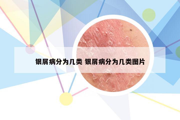 银屑病分为几类 银屑病分为几类图片