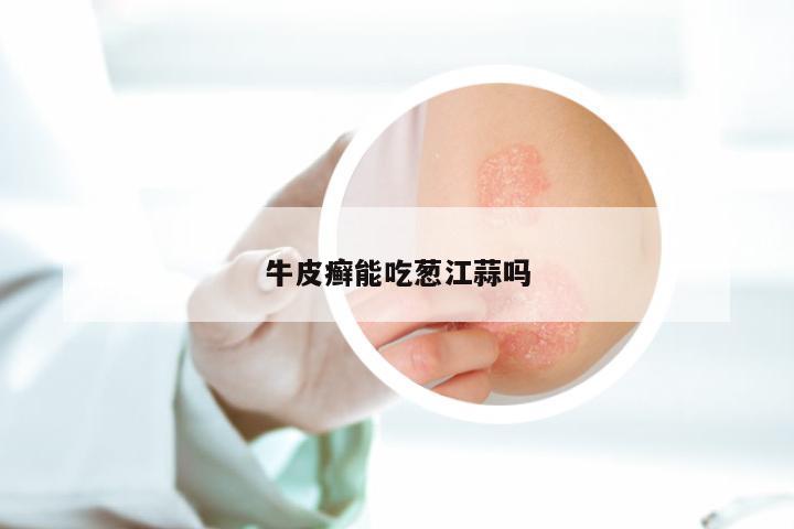 牛皮癣能吃葱江蒜吗