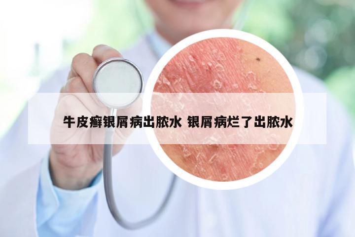 牛皮癣银屑病出脓水 银屑病烂了出脓水