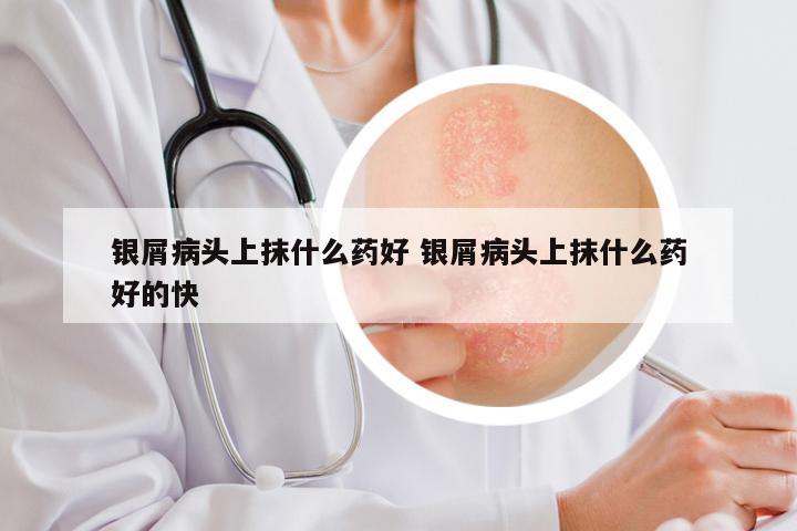 银屑病头上抹什么药好 银屑病头上抹什么药好的快