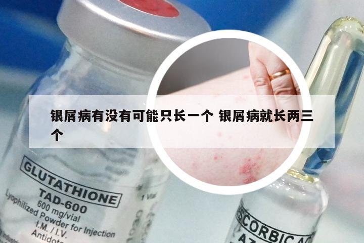 银屑病有没有可能只长一个 银屑病就长两三个