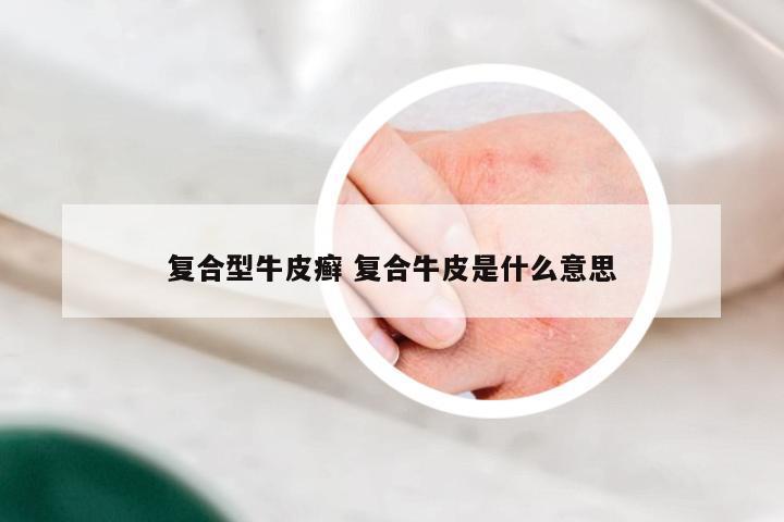 复合型牛皮癣 复合牛皮是什么意思
