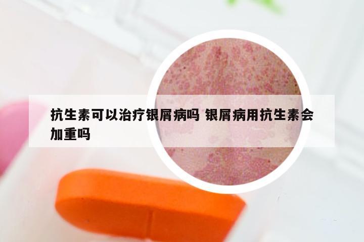 抗生素可以治疗银屑病吗 银屑病用抗生素会加重吗