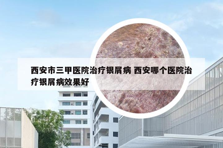 西安市三甲医院治疗银屑病 西安哪个医院治疗银屑病效果好