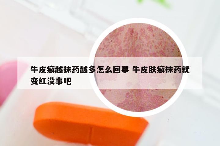 牛皮癣越抹药越多怎么回事 牛皮肤癣抹药就变红没事吧