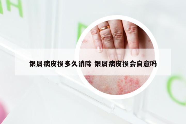 银屑病皮损多久消除 银屑病皮损会自愈吗
