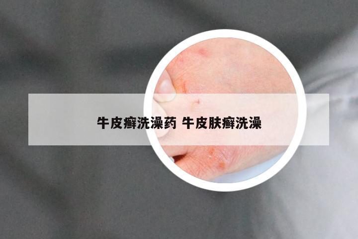 牛皮癣洗澡药 牛皮肤癣洗澡