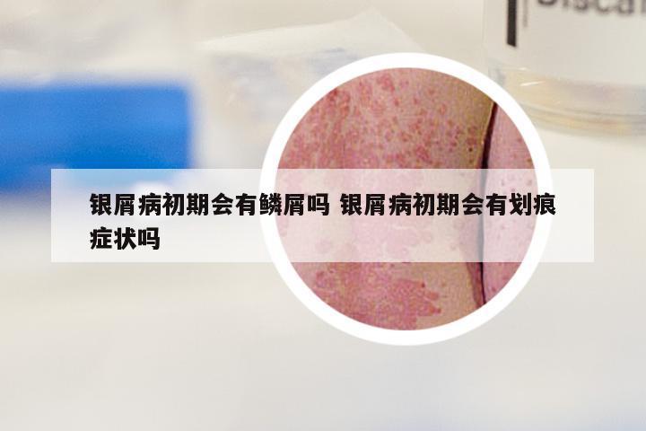 银屑病初期会有鳞屑吗 银屑病初期会有划痕症状吗