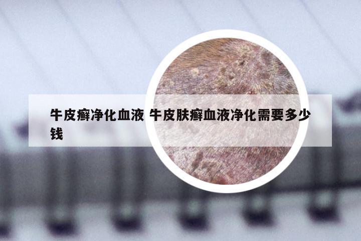 牛皮癣净化血液 牛皮肤癣血液净化需要多少钱