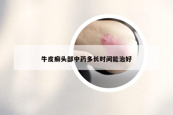 牛皮癣头部中药多长时间能治好
