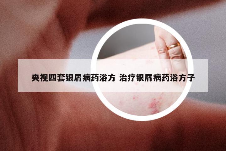 央视四套银屑病药浴方 治疗银屑病药浴方子