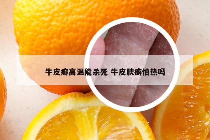 牛皮癣高温能杀死 牛皮肤癣怕热吗