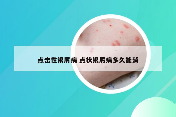点击性银屑病 点状银屑病多久能消