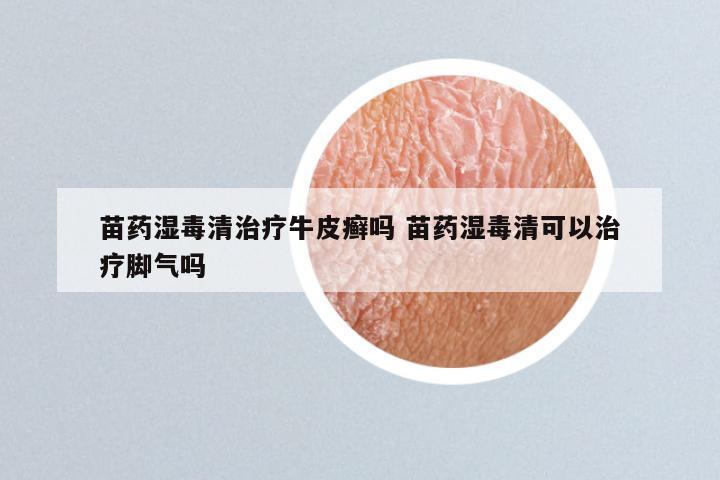 苗药湿毒清治疗牛皮癣吗 苗药湿毒清可以治疗脚气吗
