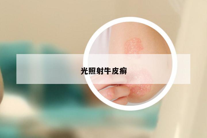 光照射牛皮癣