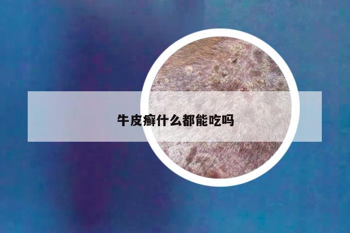 牛皮癣什么都能吃吗