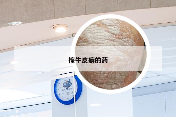 擦牛皮癣的药