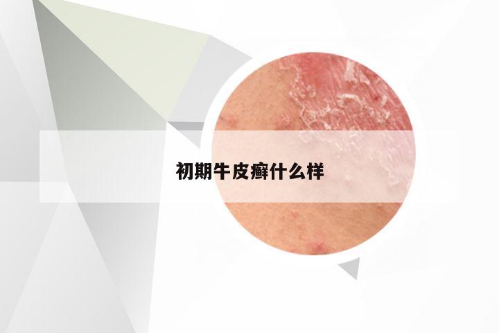 初期牛皮癣什么样