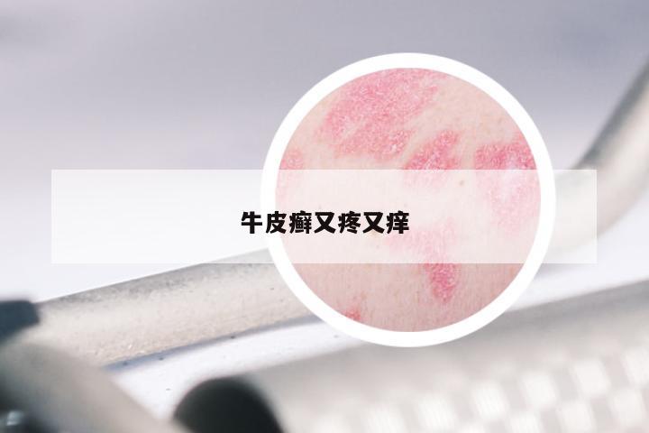 牛皮癣又疼又痒