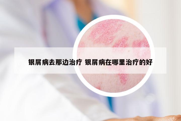银屑病去那边治疗 银屑病在哪里治疗的好