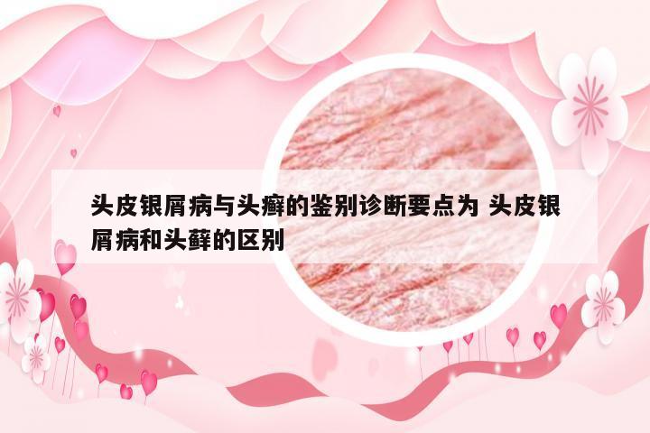 头皮银屑病与头癣的鉴别诊断要点为 头皮银屑病和头藓的区别