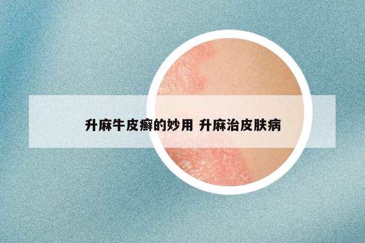 升麻牛皮癣的妙用 升麻治皮肤病