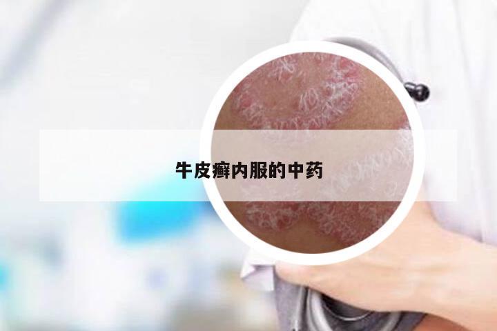 牛皮癣内服的中药