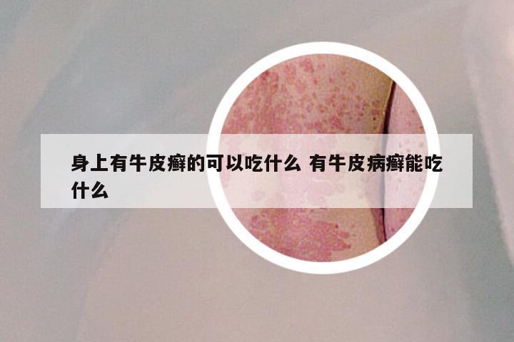 身上有牛皮癣的可以吃什么 有牛皮病癣能吃什么