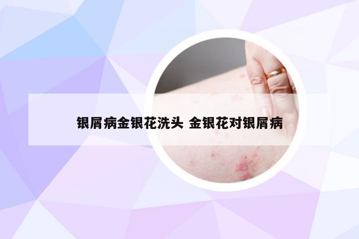 银屑病金银花洗头 金银花对银屑病
