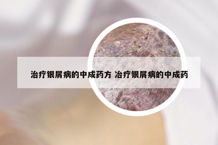 治疗银屑病的中成药方 冶疗银屑病的中成药