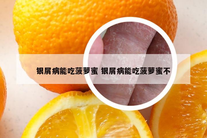银屑病能吃菠萝蜜 银屑病能吃菠萝蜜不