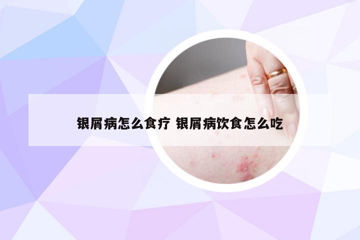 银屑病怎么食疗 银屑病饮食怎么吃