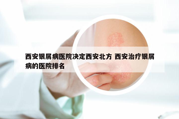 西安银屑病医院决定西安北方 西安治疗银屑病的医院排名