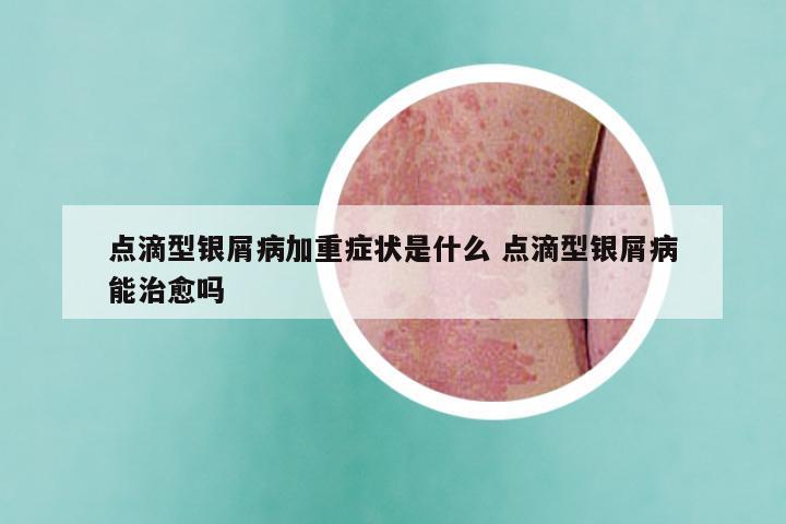 点滴型银屑病加重症状是什么 点滴型银屑病能治愈吗