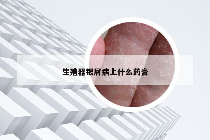 生殖器银屑病上什么药膏