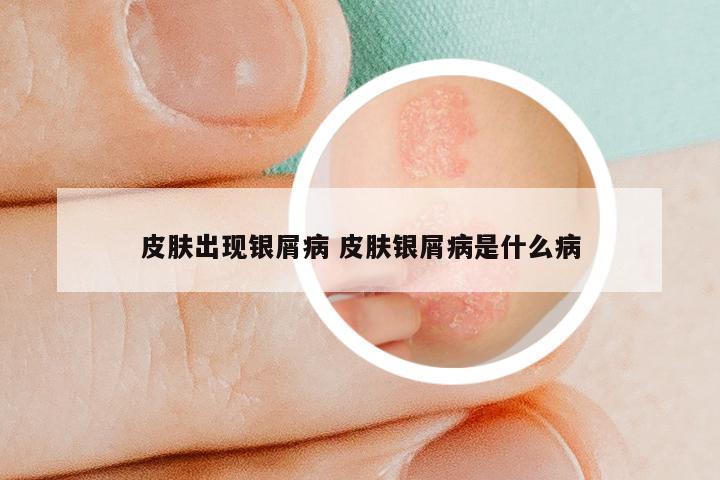 皮肤出现银屑病 皮肤银屑病是什么病