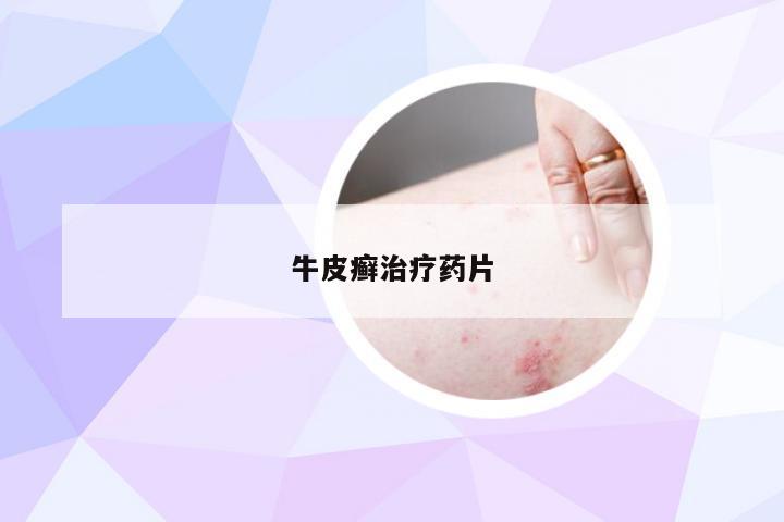 牛皮癣治疗药片