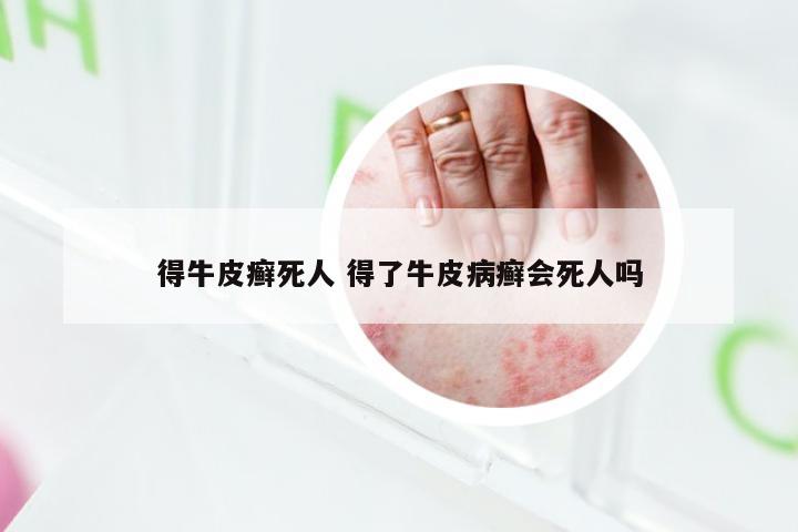得牛皮癣死人 得了牛皮病癣会死人吗