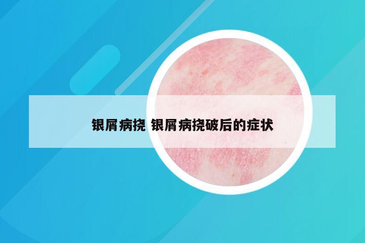 银屑病挠 银屑病挠破后的症状