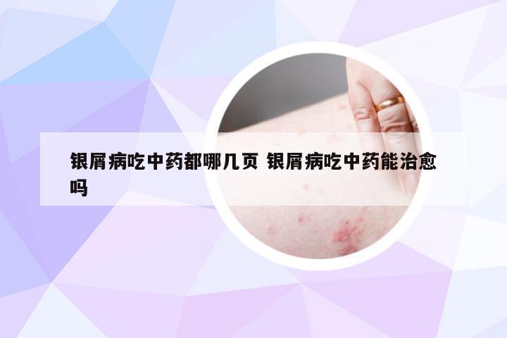 银屑病吃中药都哪几页 银屑病吃中药能治愈吗