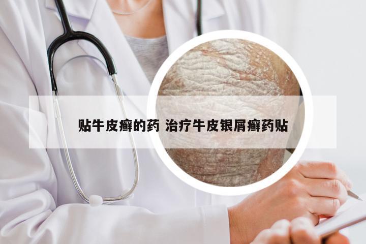 贴牛皮癣的药 治疗牛皮银屑癣药贴