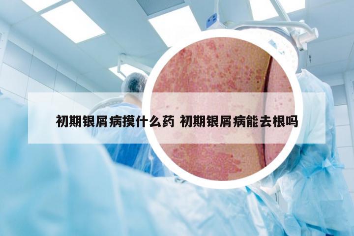初期银屑病摸什么药 初期银屑病能去根吗